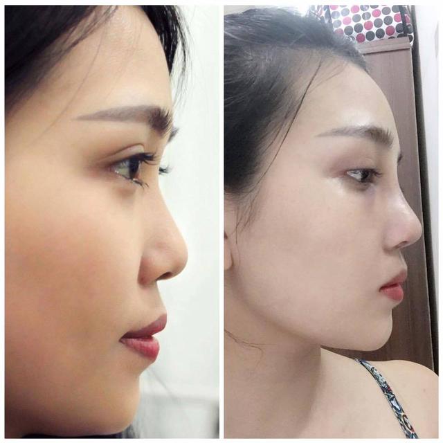 Sau S-line, kỹ thuật n&acirc;ng mũi d&aacute;ng S-Mode lại đang &ldquo;dậy s&oacute;ng&rdquo; - Ảnh 2.
