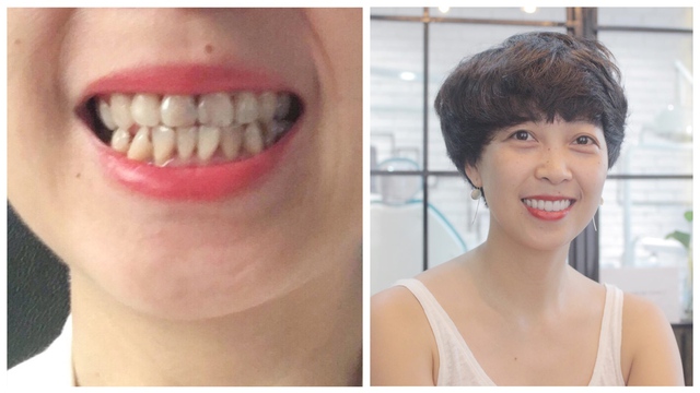 Nhìn loạt ảnh trước và sau khi làm răng sứ - Bạn cũng chỉ muốn đến ngay nha sĩ thôi - Ảnh 2.