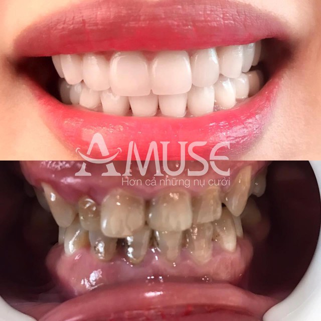 Nhìn loạt ảnh trước và sau khi làm răng sứ - Bạn cũng chỉ muốn đến ngay nha sĩ thôi - Ảnh 8.