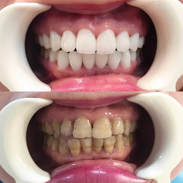 Nhìn loạt ảnh trước và sau khi làm răng sứ - Bạn cũng chỉ muốn đến ngay nha sĩ thôi - Ảnh 10.