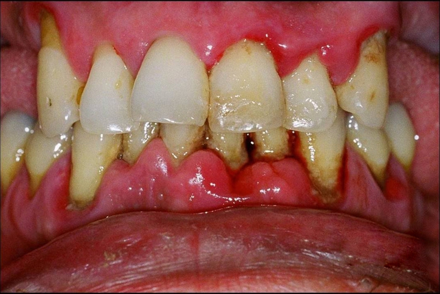Một số lưu ý cần tìm hiểu trước khi bọc răng sứ - Ảnh 3.