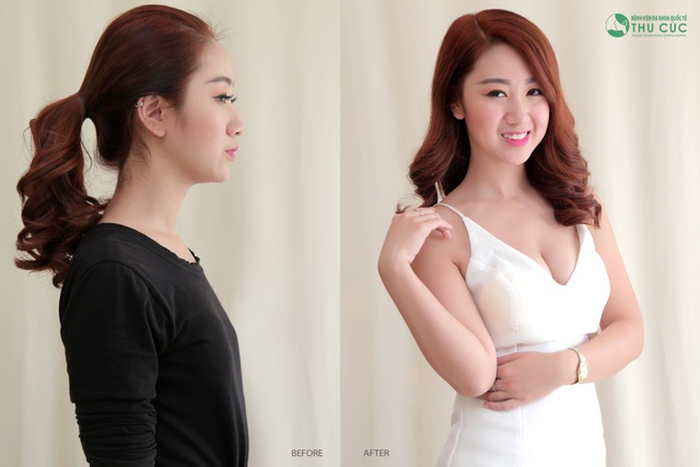 Cứ v&agrave;o h&egrave; chị em lại c&oacute; th&ecirc;m l&yacute; do k&eacute;o nhau đi n&acirc;ng ngực - Ảnh 1.