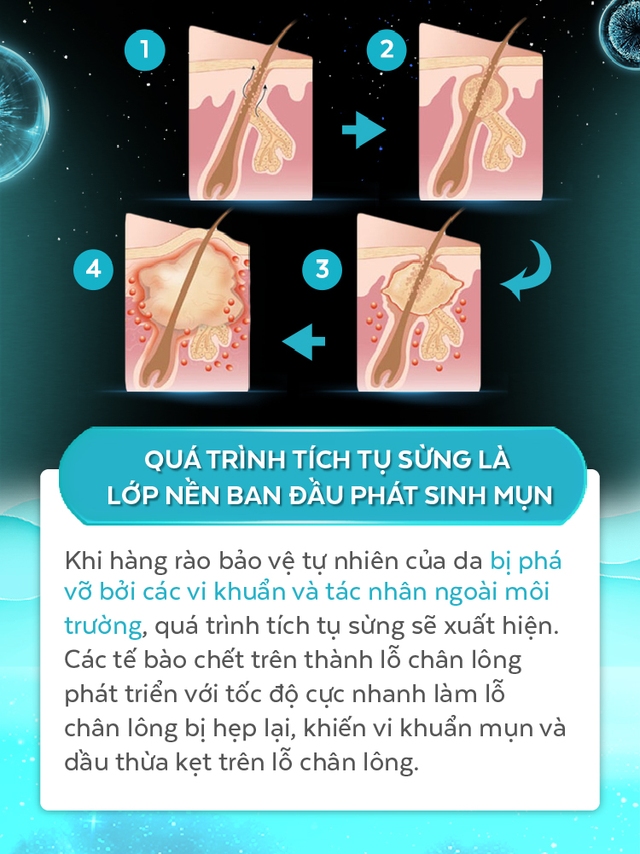 Giải đáp từ A đến Z cơ chế gây mụn ở tuổi dậy thì, hóa ra vi khuẩn không xấu như chúng ta vẫn nghĩ - Ảnh 4.